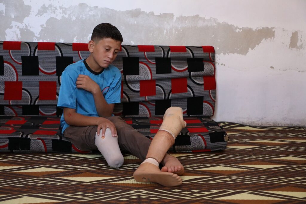 Junge mit amputiertem Bein sitzt auf einer Couch und schaut nachdenklich auf seine Beine.