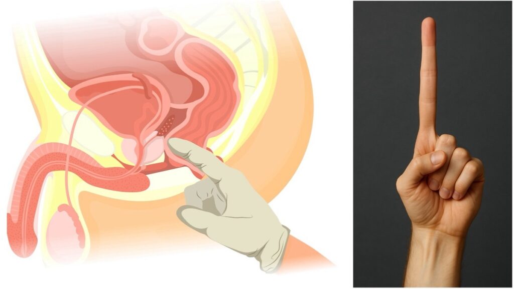 Prostatakrebsvorsorge: Abtasten bringt nichts! / PSA Test und MRT setzen sich durch