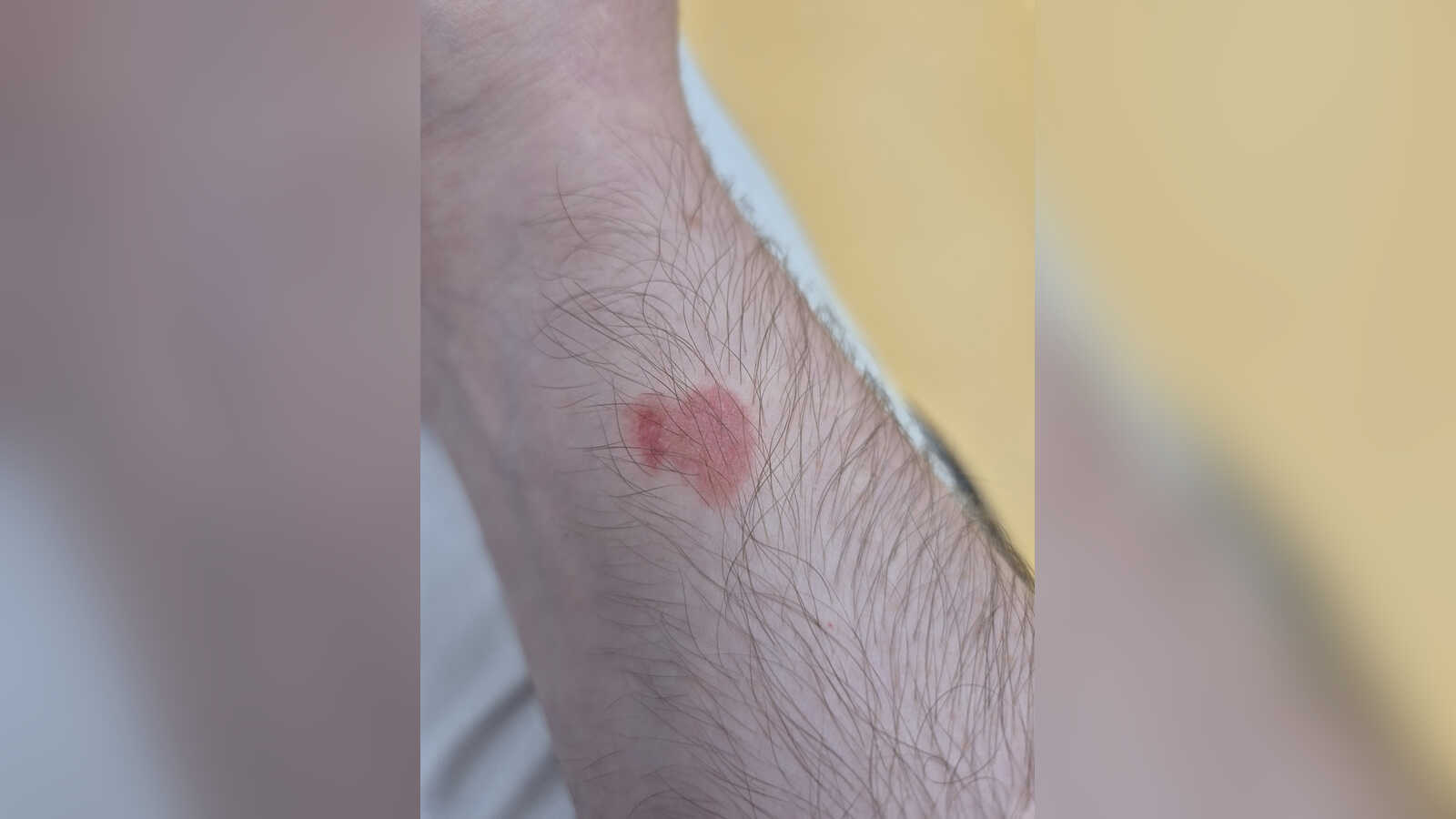Gerötete Hautstelle am Handgelenk nach Kontakt mit Phenol