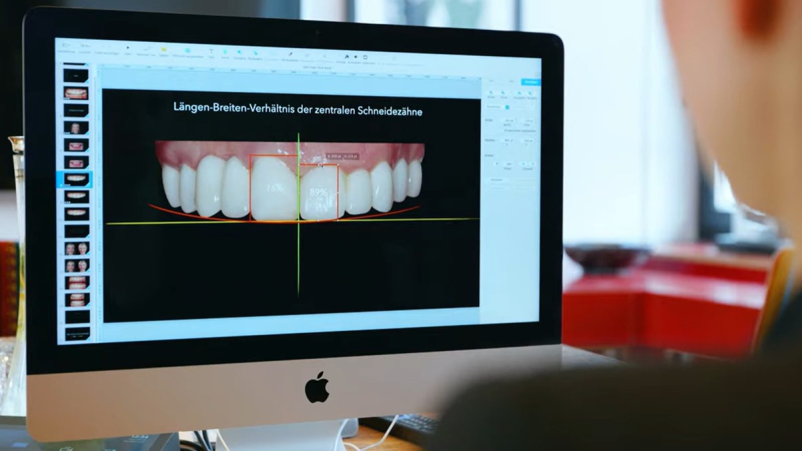 Mit Digital Smile Design kann das neue Lächeln am Bildschirm geplant werden. © KU64 / Weiterer Text über ots und www.presseportal.de/nr/181398 / Die Verwendung dieses Bildes für redaktionelle Zwecke ist unter Beachtung aller mitgeteilten Nutzungsbedingungen zulässig und dann auch honorarfrei. Veröffentlichung ausschließlich mit Bildrechte-Hinweis.