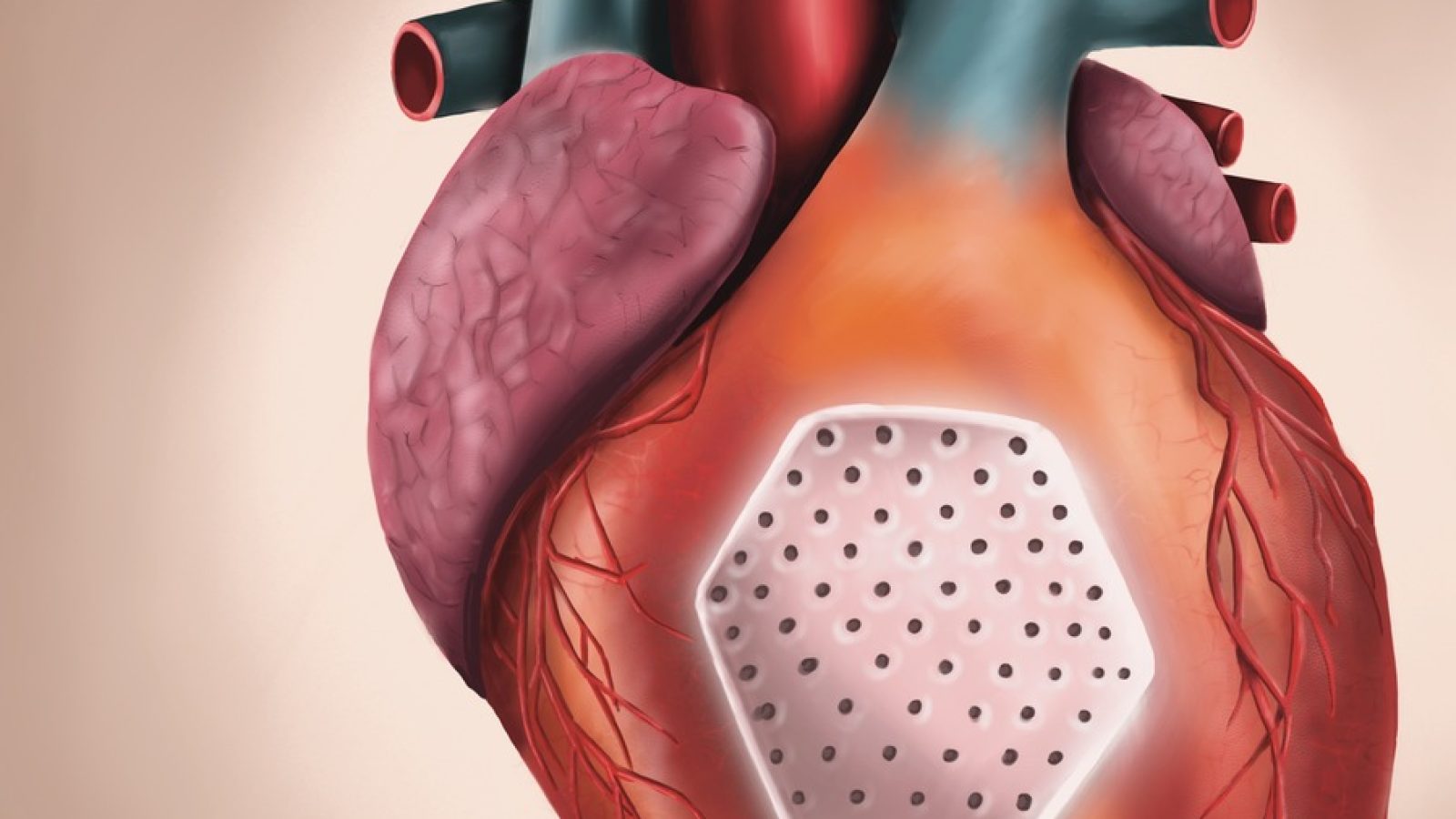 Das Herzplaster / Weiterer Text über ots und www.presseportal.de/nr/180960 / Die Verwendung dieses Bildes für redaktionelle Zwecke ist unter Beachtung aller mitgeteilten Nutzungsbedingungen zulässig und dann auch honorarfrei. Veröffentlichung ausschließlich mit Bildrechte-Hinweis.