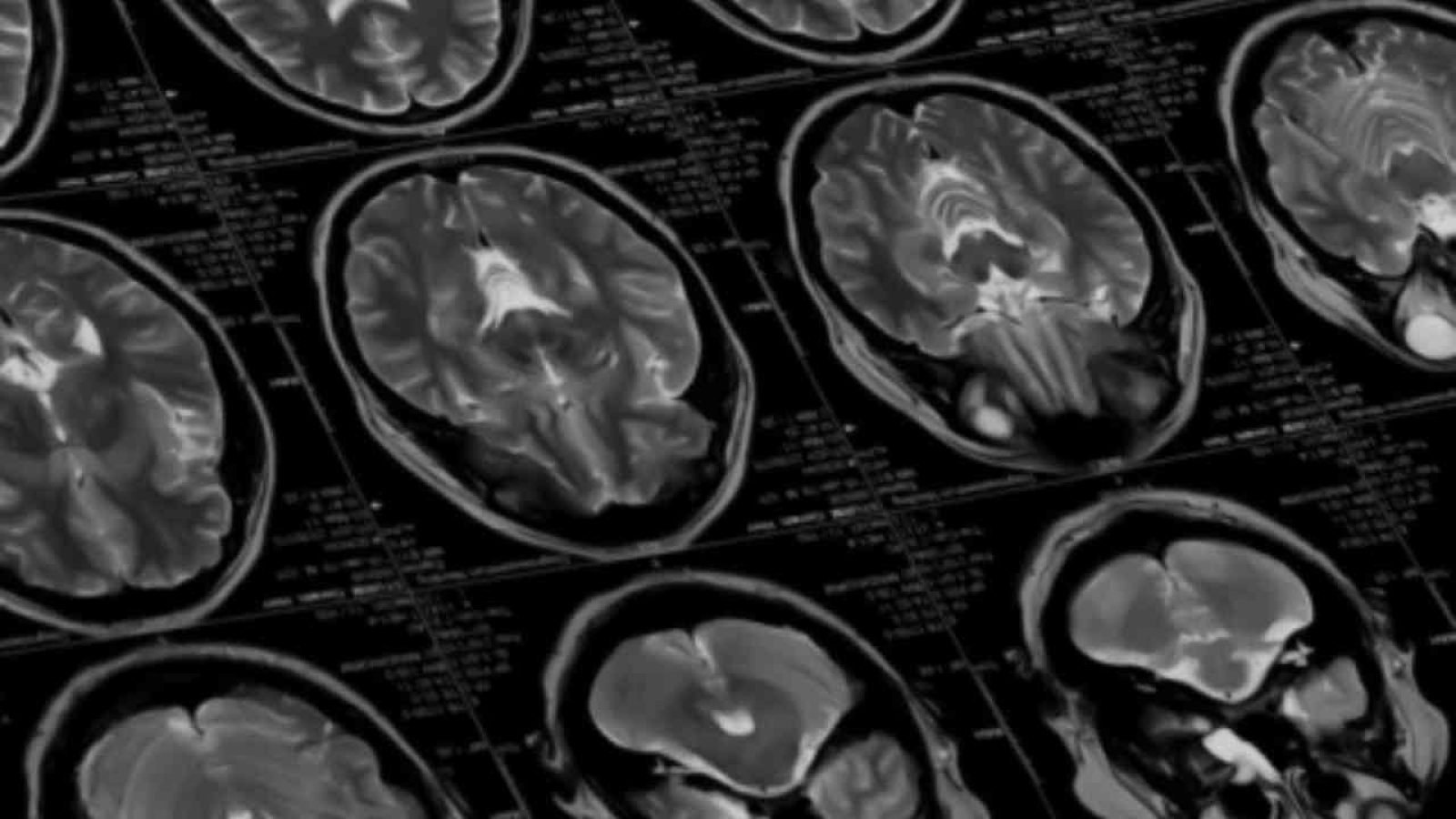 neurotherapie-ohne-operation-mit